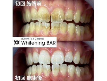 ホワイトニングバー 福島店/初回ビフォーアフターをご紹介