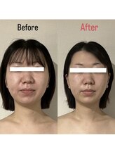 ハイコガオ 中崎町店(HIKOGAO)/小顔矯正