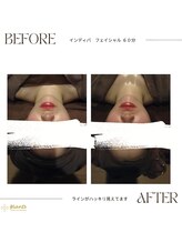 グランツ 小山店/インディバフェイシャル60分