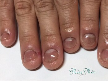 パラジェル認定サロン メールメール 池袋店(MereMer)/（経過）110 深爪 深爪緩和 ケア