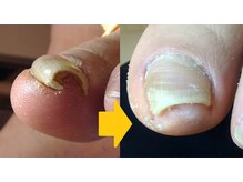 ドクターネイル爪革命 秋津店/巻き爪ケア