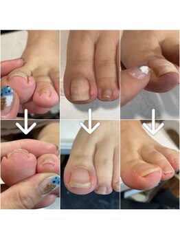 リゾートデバリ(ReSORT de BALI)/巻き爪矯正~~~♪゛