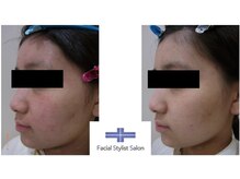 フェイシャルスタイリストサロン 高崎店(Facial Stylist Salon)/ケア例（7）