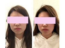 ユズ(yuzu)/◆エラ張りを解消したい