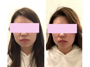 ユズ(yuzu)/◆エラ張りを解消したい