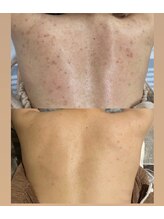 ノイ(Noi)/本気の肌質改善