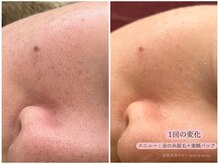 レスイズモア 恵比寿(less is more.)の雰囲気（金の糸脱毛でむきたまご肌［ニキビケア/肌質改善/フェイシャル］）