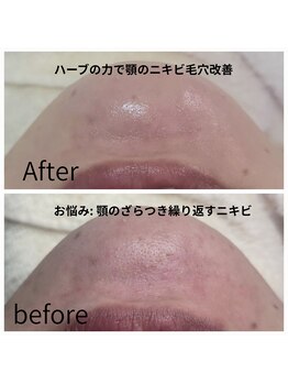 サロン ザ プマロ(SalonThePumalo)/ハーブビーリング1回目