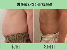 ソルニス(Solnis.)/痩身☆脂肪分解/ハイパーナイフ