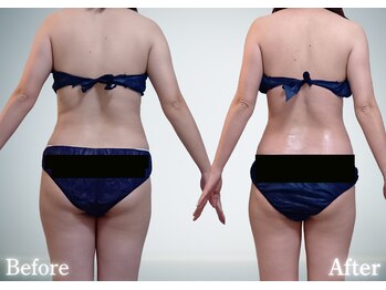 サンティエ(Santie)の写真/【脂肪別にマシーンを使用】頑固な脂肪も最大5種類の最新痩身マシーンを使用し徹底撃退≪効果実感大≫