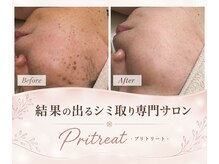 プリトリート(Pritreat)