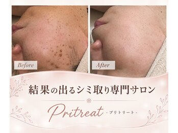 プリトリート(Pritreat)の写真/【気になる首のブツブツに】夏までにスッキリ綺麗に/首orボディコース