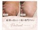プリトリート(Pritreat)の写真/【気になる首のブツブツに】夏までにスッキリ綺麗に/首orボディコース