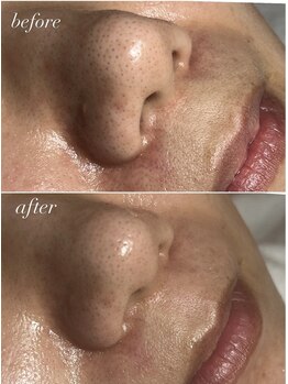 スパークル/毛穴/毛穴洗浄/ワックス/脱毛