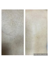 オアジスパ(Oasi Spa)/黒いプツプツサメ肌４回