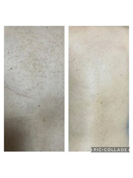 オアジスパ(Oasi Spa)/黒いプツプツサメ肌４回