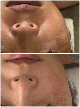 リアム(Liam)/難しかったシミ緩和もアプローチ