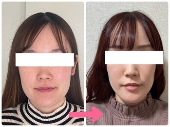 小顔矯正サロン ブルーム/シャープなフェイスラインへ