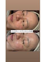 ココリール/乾燥・赤み