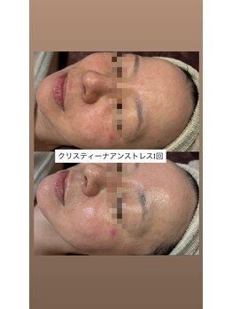 ココリール/乾燥・赤み