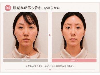 モアフェイス 池袋店(More Face)/肌ツヤ・フェイスライン・たるみ