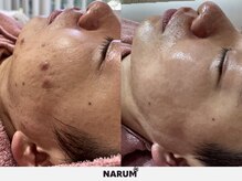 ナルムフェイシャル 代々木(NARUM facial)/水光ピーリング