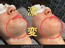 ラピスダズル(LAPIS DAZZLE)/ひげ脱毛☆途中経過