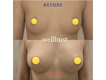バストアップ専門店 ウェルバスト 福岡天神店(Well Bust)/バストアップ症例【5】