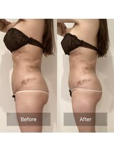 アラマンダ(Allamanda)/腹部吸引BeforeAfter