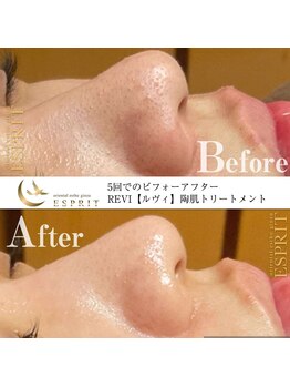 エスプリ 銀座店/ハーブピーリングI銀座