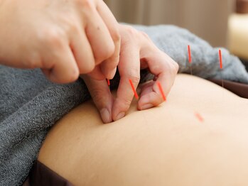 大宮ウィル鍼灸整骨院/気になるところに鍼灸施術!