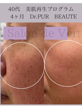 サロン ド ヴェール 一宮店(Salon de Vert)/Dr.ピュールボーテのプログラム
