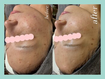 ミウル 天王寺店(miulu)/30代/シミケア照射＋ハーブ6回