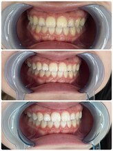 グリッター ショウナン(glitter. SHONAN)/2回来店セルフホワイトニング