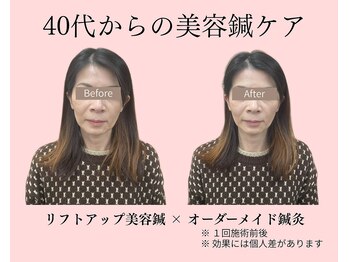 望鍼灸院/美容鍼の施術前後　１