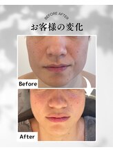エムボーテ 太田店(M BEAUTE33)/顔筋小顔コルギ