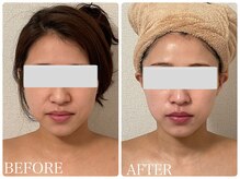 イリゼ(IRISER)/【30代リフトアップ】即実感ケア