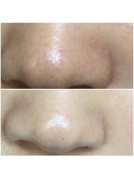 カルム(Calme)/お顔脱毛で小鼻の黒ずみ解消