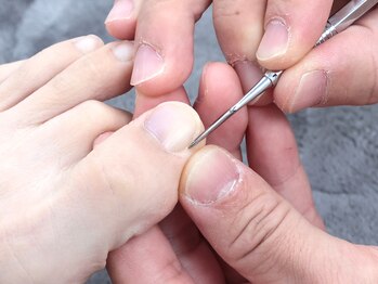 あゆむ鍼灸接骨院/★施術風景★巻き爪.陥入爪.