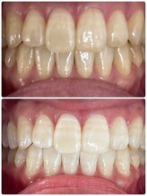 エクシアホワイトニング 札幌中島公園店/Before After［ホワイトニング］