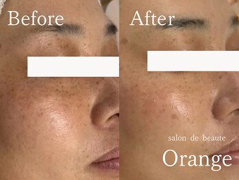 サロンドボーテ オランジュ(salon de beaute Orange)/くすみシミ撃退