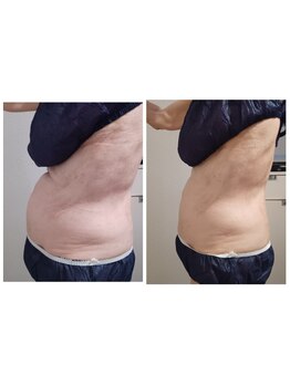 ルクソール/レモンボトル(痩身)