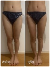 エルール トータルビューティ(Aileure total beauty)/術後ケア　太もも