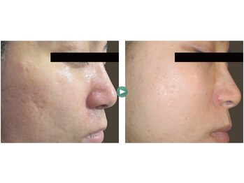 ハルリ(Haruri)/エステダーマ