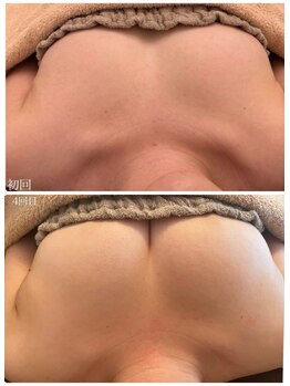 美人バスト 本厚木店/バストアップ◇症例◇