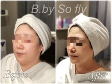 ビードット バイ ソーフライ(B.by So fly)/大人気！効果絶大◎大人の美顔