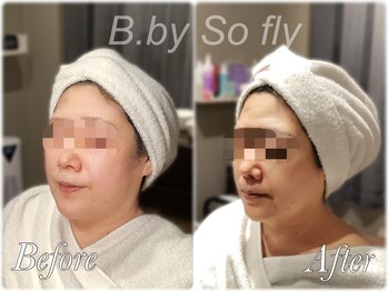 ビードット バイ ソーフライ(B.by So fly)/大人気！効果絶大◎大人の美顔