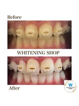 ホワイトニングショップ 小山店/【ビフォーアフター】