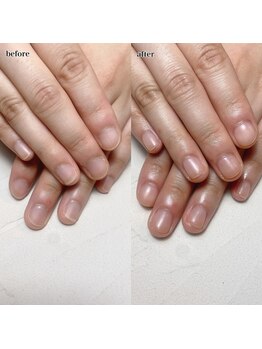 自爪風深爪矯正