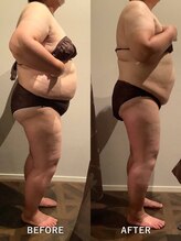 エステサロンルシア (LUCIA)/ラジオ波セル吸引撃退90分コース